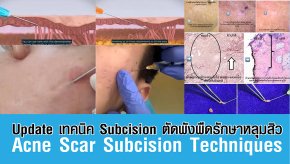 Update เทคนิค Subcision ตัดพังผืดรักษาหลุมสิว Acne Scar Subcision Techniques